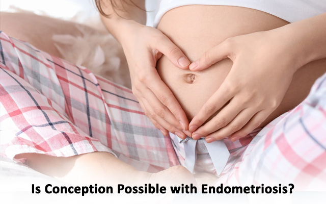 endometriosis stages