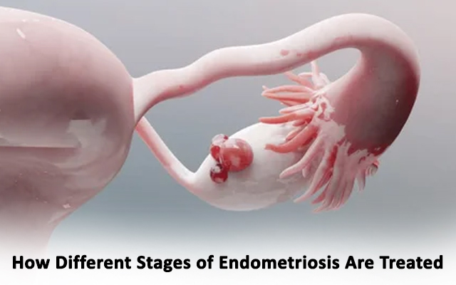 Endometriosis Stage