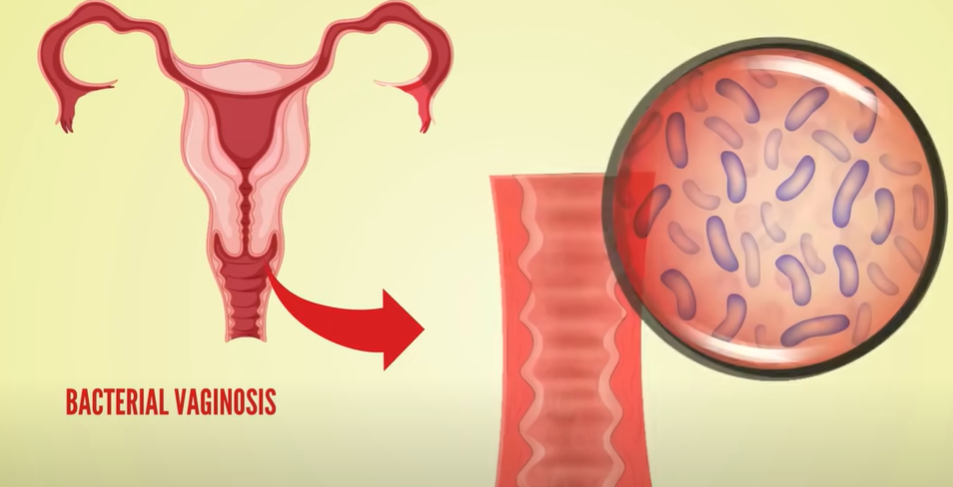 Bacterial Vaginosis