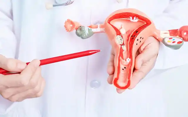 Symptoms of PCOS including acne, excess hair growth, weight gain and skin darkening in women